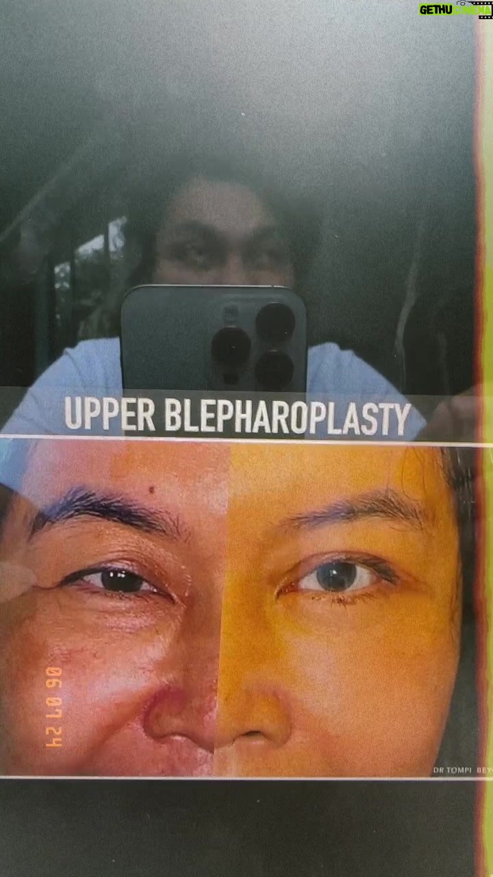 Tompi - 694 Likes - Penjelasan kali ini tentang OPERASI KELOPAK MATA : kasus ptosis ,aging eyes yg kelopaknya turun, atau kasus koreksi pasca op kelopak sebelumnya
Oh ya perawtaan kulit sy hanya basic skin care dari @geut.id : sabun moisturizer sunblok dan kolagennya. Treatment TREJUVV/1x tiap 4bulan dan Tplasma 1x/bulan
Tsilk 1x/bulan di Beyoutiful klinik
Yak Silahkan disimak. Pertanyaan bisa DM ya atau datang lansung ke @beyoutiful.aesthetic di @t_spacebintaro atau cabang pakubuwono
Prosedur ini juga bs dikerjakan di seluruh cabang @beyoutifulbydrtompi ; JOGJA MAKASAR BALI BANDUNG BEKASI SURABAYA PIK ALAMSUTERA KELAPAGADING BOGOR