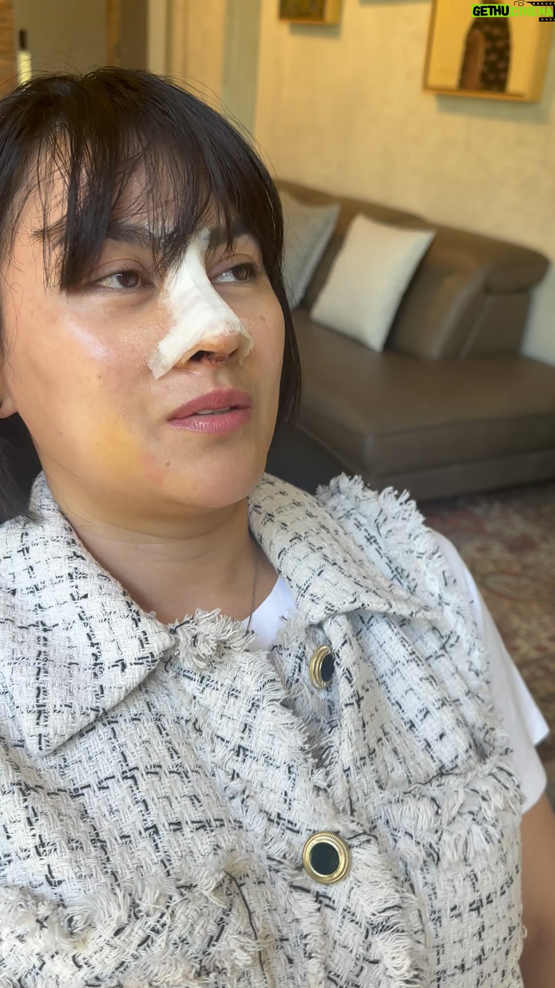 Tompi - 5.7K Likes - Hari ke 7 post Rhinoplasty iga: bengkak sedikiiiittt. Jd gak malu2 in lah. Bentuknya mulai keliatan. Sangat dianjurkan utk tetap pasang plester 3-4 mggu setelahnya tp dah bs buka pasang. Hasil bentuk final biasanya akan tampak makin kece dalam 3-6 bulan ke depan. Kl sakit; udah pasti gak dong…