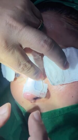 Tompi Instagram - Begini caranya pasang fiksasi abis op rhinoplasty iga. Hari ke 3 dah dilepas. Pasien bs tetap nafas dr idung, jd nyaman.