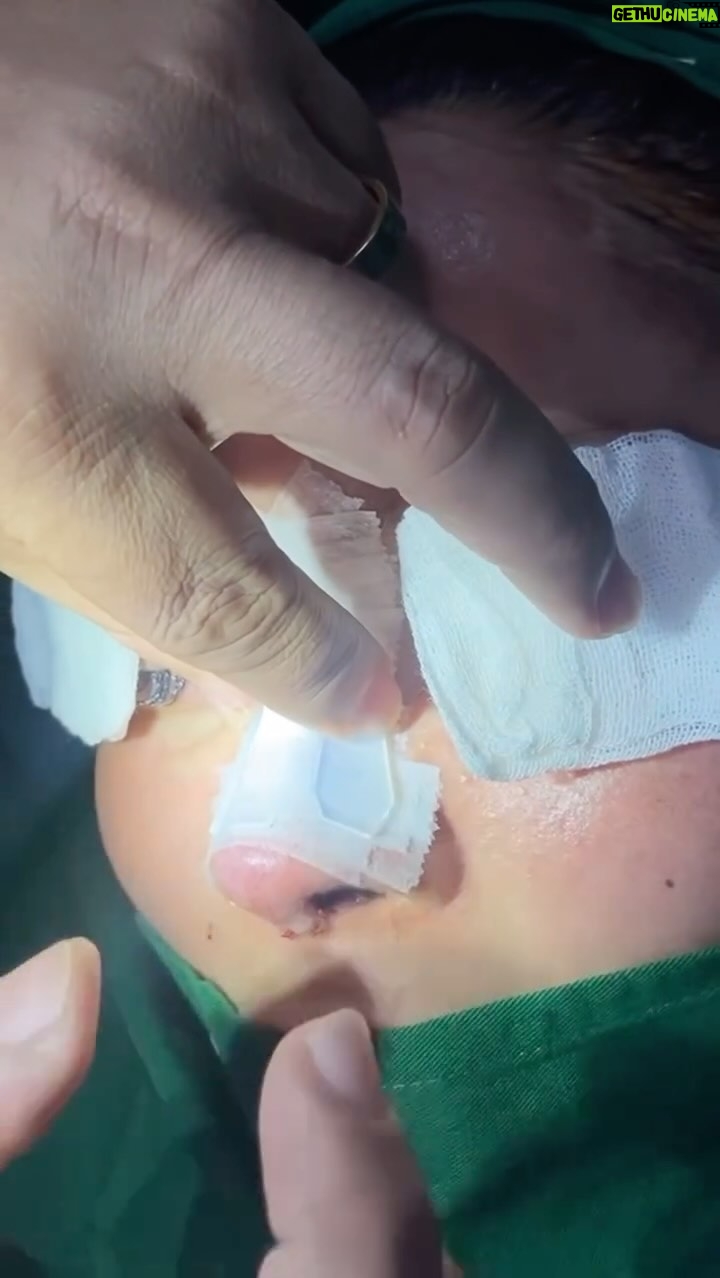 Tompi - 596 Likes - Begini caranya pasang fiksasi abis op rhinoplasty iga. Hari ke 3 dah dilepas. Pasien bs tetap nafas dr idung, jd nyaman.