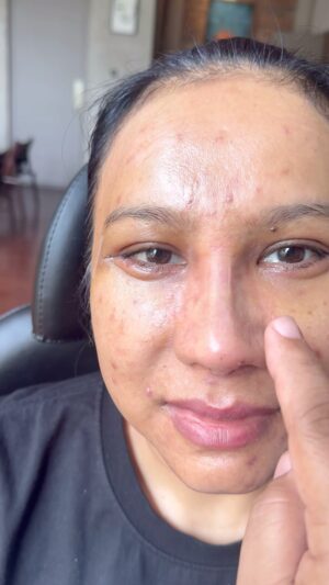 Tompi Instagram - Cabut plester hr ke 2 post Rhinoplasty iga dan mid facelifting, bengkak memar minimal sekali, nyeri: gak dong. Aktifitas bebas

Pasien riwayat filler dan benang. Jd dibersihkan lalu lansung di koreksi 

Dan sekalian treatment trejuvv tplasma utk jerawat dan tekstur kulitnya