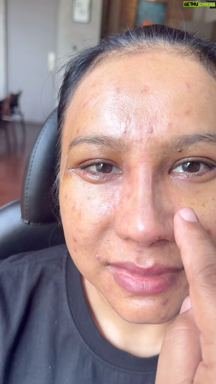 Tompi - 869 Likes - Cabut plester hr ke 2 post Rhinoplasty iga dan mid facelifting, bengkak memar minimal sekali, nyeri: gak dong. Aktifitas bebas
Pasien riwayat filler dan benang. Jd dibersihkan lalu lansung di koreksi
Dan sekalian treatment trejuvv tplasma utk jerawat dan tekstur kulitnya