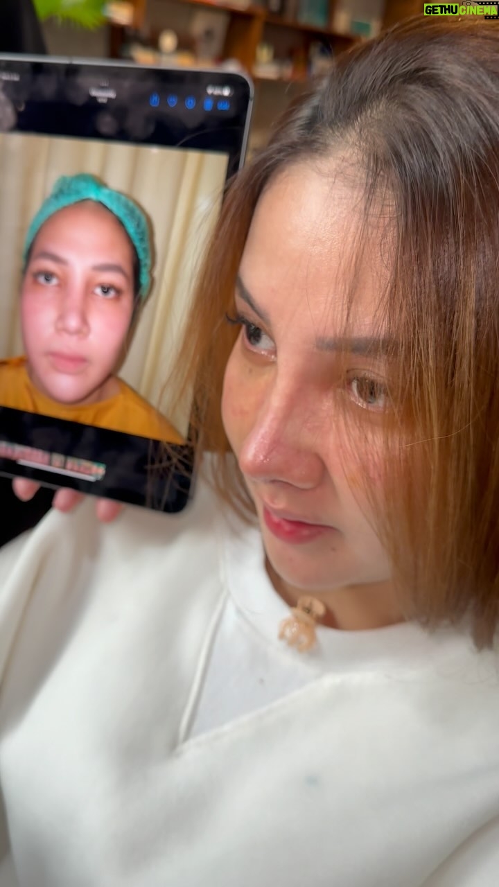 Tompi - 1.5K Likes - Hari ke 5 post Rhinoplasty IGA setelah riwayat 2x implant sebelumnya miring.
Op dilakukan rhinoplasty Iga ( jd gak pake implant sama sekali)
Kok bs minimal bengkak? Kok bs Gak sakit?
Nah kita bahas pas konsul ya
BEYOUTIFUL T-SPACE BINTARO9
telp 0811 8111 0558 0811 8111 0559
BEYOUTIFUL PAKUBUWONO
jl PAKUBUWONO VI no 5a jaksel
62 821-1303-5099 0217211025