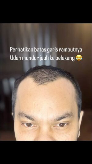 Tompi Instagram - Gak berasa dah 10bulanan sejak tanam rambut di @beyoutifulhairtransplantcenter .  GAK PAKE SAKIT  sama sekali, dan bs padat rapat bgini. Pasca tindakan aktifitas normal ajaa kok. Nah utk detail mampir aja konsul. 
BEYOUTIFUL T-SPACE BINTARO9 
telp 0811 8111 0558  0811 8111 0559 

BEYOUTIFUL PAKUBUWONO 
 jl PAKUBUWONO VI no 5a jaksel 
  62 821-1303-5099  0217211025