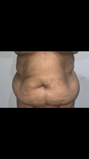 Tompi Instagram - Emang bs sekecil apa sih abis tummytuck n liposuction?

Jangan lupa ada paket khusus selama JUNI 2024 utk tummytuck lipo body lengan paha dan breast augmentation 

Nah SEMUA PERTANYAAN LANJUTAN KITA BAHAS SAAT KONSUL YA 😝

BEYOUTIFUL T-SPACE BINTARO9  telp 0811 8111 0558  0811 8111 0559  BEYOUTIFUL PAKUBUWONO  jl PAKUBUWONO VI no 5a jaksel  62 821-1303-5099  0217211025