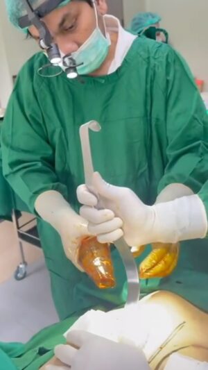 Tompi Instagram - Breast augmentation (menambah volume payudara) dan breast lifting (mengencangkan payudara yg kendur/turun) adalah 2 prosedur yg berbeda. Keduanya bs dikerjakan bersamaan bika memang perlu.  Bila payudara turun namun besarnya cukup—- maka bs dikencangkan tanpa implan

Dual plane technique dan “no touch approach “ dengan sayatan minimal menjadi SOP Beyoutiful 

Silhakan konsultasikan case nya utk selanjutnya akan kami design sesuai kebutuhan

Prosedur ini dikerjakan oleh tim breast beyoutiful
@risatoci @uthelumbuun @jei.nabila @dr.supit