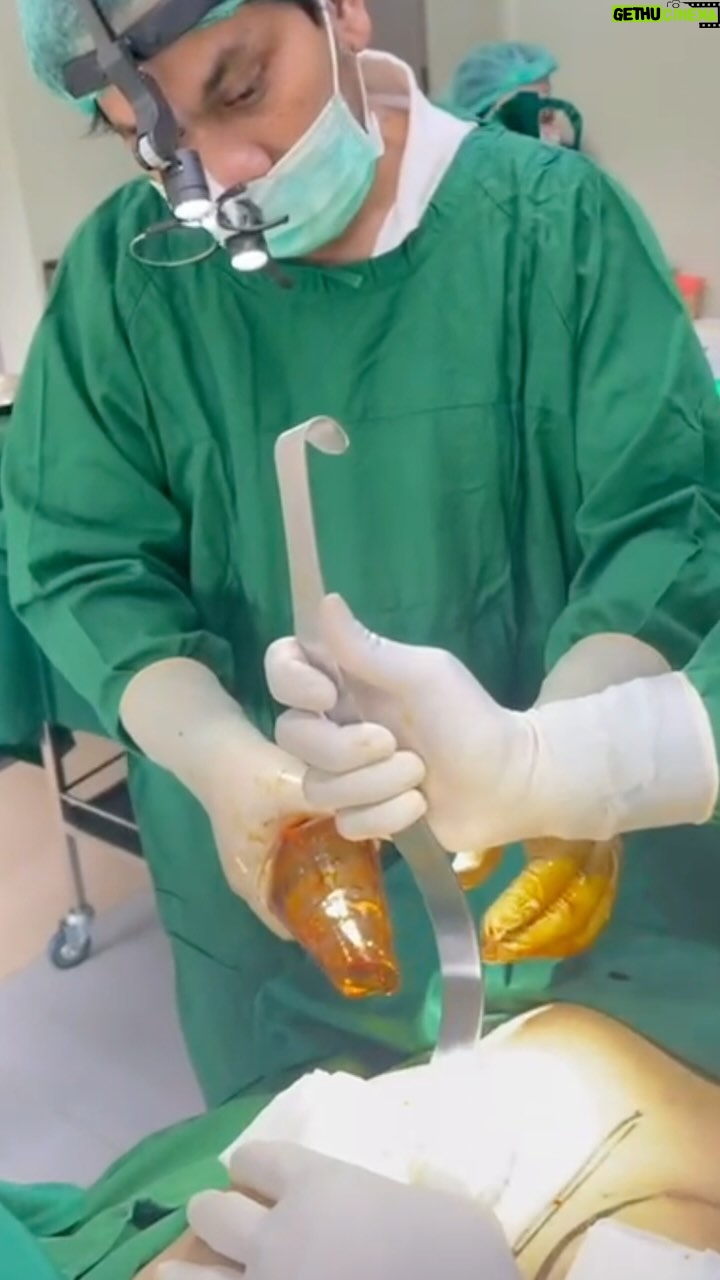 Tompi - 9K Likes - Breast augmentation (menambah volume payudara) dan breast lifting (mengencangkan payudara yg kendur/turun) adalah 2 prosedur yg berbeda. Keduanya bs dikerjakan bersamaan bika memang perlu. Bila payudara turun namun besarnya cukup—- maka bs dikencangkan tanpa implan
Dual plane technique dan “no touch approach “ dengan sayatan minimal menjadi SOP Beyoutiful
Silhakan konsultasikan case nya utk selanjutnya akan kami design sesuai kebutuhan
Prosedur ini dikerjakan oleh tim breast beyoutiful
@risatoci @uthelumbuun @jei.nabila @dr.supit