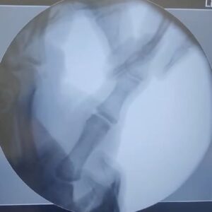 Bienve Aguado Alba Instagram - Thumbs up!! 👍🏼 Surgery went well.

Decided to get surgery to stabilize my thumb properly so I'm able to do crazy shit again and avoid future problems.

Thanks @dr_sergialabau and @icatme_ma 🙏🏼

I should be back in 3/4 weeks.