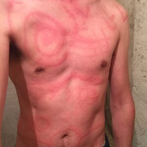Bruno Muschio Instagram - Vous ai-je déjà parlé de mon dermographisme ?