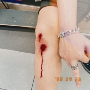 Chen Mu Instagram - 大意了，沒有閃。
🛹撲街紀錄💥
🩸 🩸 🩸
特別感謝大安藥局（絕無置入😹
2022/9/26