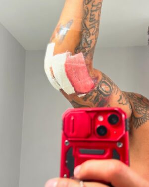 Eryk Anders Instagram - Healing up nicely… I think