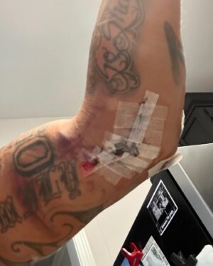 Eryk Anders Instagram - Healing up nicely… I think