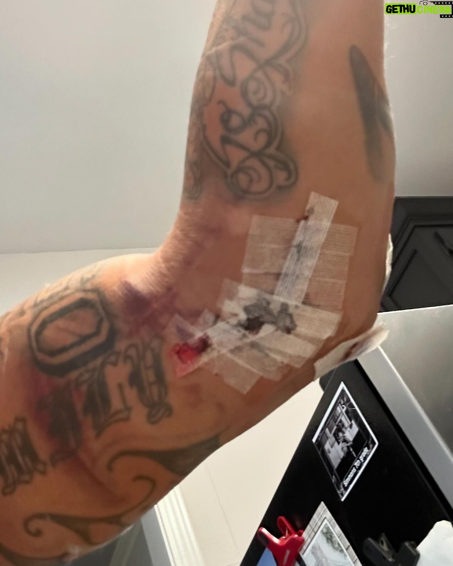 Eryk Anders - 345 Likes - Healing up nicely… I think