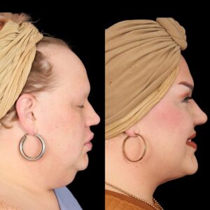 Eureka O'Hara Instagram - Check out @eurekaohara and her progress three month's post-op. Check back tomorrow to hear more about the procedure and what we did to achieve these results. What's our favorite response from her? She can breath better at night! The weight under chin has been lifted for her. 

We love Eureka and are so grateful she has picked us to be in charge of her care. Thank you for choosing Davis Facial Plastics!

⭐ Buccal Fat Removal
⭐ Upper Blepharoplasty
⭐ Platysmaplasty
⭐ Submental Liposuction

📞 (424) 284-3164
🌐 davisfacialplastics.com
📍 9440 Santa Monica Blvd Suite 708, Beverly Hills, CA 90210 
📷 These photos are used with explicit consent from the patient.

#eurekaohara #eureka #platysmaplasty #plasticsurgeon #plasticsurgery #beverlyhills #expert #buccalfatremoval