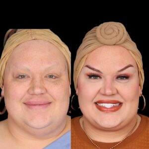 Eureka O'Hara Instagram - Check out @eurekaohara and her progress three month's post-op. Check back tomorrow to hear more about the procedure and what we did to achieve these results. What's our favorite response from her? She can breath better at night! The weight under chin has been lifted for her. 

We love Eureka and are so grateful she has picked us to be in charge of her care. Thank you for choosing Davis Facial Plastics!

⭐ Buccal Fat Removal
⭐ Upper Blepharoplasty
⭐ Platysmaplasty
⭐ Submental Liposuction

📞 (424) 284-3164
🌐 davisfacialplastics.com
📍 9440 Santa Monica Blvd Suite 708, Beverly Hills, CA 90210 
📷 These photos are used with explicit consent from the patient.

#eurekaohara #eureka #platysmaplasty #plasticsurgeon #plasticsurgery #beverlyhills #expert #buccalfatremoval