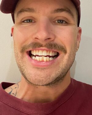Jamie Watt Instagram - Ça fait maintenant 3 ans que je fréquente la clinique dentaire Grande Allée et Dre Vachon. Pour la première fois de ma vie, j’apprécie aller chez le dentiste. Oui, vous avez bien compris j’aime aller chez le dentiste!!! Dre Nathalie Vachon travaille depuis plus de 30 ans dans le domaine de l'esthétique dentaire et consacre plus de 300 heures par année à des formations post-universitaires pour perfectionner son savoir-faire. Pas besoin de vous dire que c’est une experte dans son domaine. Sur ce, je vous laisse mon avant/après de ma transformation dentaire, pour que vous puissiez constater par vous-même. Sans oublier le lien si tu veux toi aussi avoir la meilleure dentiste en ville.
Merci @institutdentairegrandeallee 

https://www.idga.ca/a-propos/dre-nathalie-vachon/