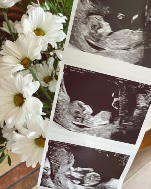 Jamie Watt Instagram - Photo dump de notre gender reveal intime 💙👶🏼
Pour ceux qui ne reconnaissent pas l’endroit droit c’est là où nous avions filmé notre saison D’Occupation Double, la même place où moi et James se sont rencontrés pour la première fois 🤍🤍

Merci à la clinique @cliniqueovo.prenatal pour le service au delà de nos attentes 🥺 la clinique a pris charge de faire notre première échographie ainsi que la prise de sang pour savoir le sexe de notre bébé ainsi que la prise de sang Harmony pour la Trisomie. Nous avons tellement aimé notre visite à la clinique 🤍 je vous partage le moment où nous avions entendu son petit cœur pour la première fois bientôt 🥺

#intimategenderreveal #genderrevealideas #babyboyreveal
