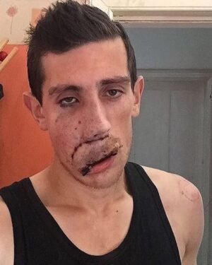Katie Piper Instagram - Todays #MindsetMonday comes from @vmrory1993, he says “I’m Rory, I’m 30, and I was born with a birthmark called a venous malformation on my upper lip and right cheek, which I had around 20 operations on when I was younger to reduce the size of it.

Growing up I had to endure a great deal of prejudice and mental abuse which by the time I had reached my teenage years had completely shattered my confidence. I was very shy and felt like I was living a never ending nightmare.

People told me that I was ugly. People told me that they would kill themselves if they looked like me. People told me I would never achieve certain things in life, and because my confidence was so low I started to believe them.

I have now achieved everything that people told me that I wouldn’t, and more. With strength and positivity I have completely overcome the adversity I’ve faced in the past, and I want to show everyone that you can get through any low points that you might experience in your lifetime.

At one point I thought I was always going to be unhappy and shy, but here I am now happier and more confident than I ever thought I would be.I have even turned down the opportunity for further surgery to make my face ‘symmetrical’ because I am happy the way that I am.

Prejudice is a horrible thing, and nobody should ever be judged or subjected to abuse purely because of what they look like, their race, their sexuality or any other reason. There are people who have been killed due to prejudice, there are people who end their own lives due to prejudice.

There are people who aren’t comfortable in their own skin, all because of the prejudice that they have to face which is absolutely heart breaking. We live in a very multi cultural and diverse planet - and nobody should be made to feel like they don’t belong here.

Diversity is a beautiful thing, which should be celebrated and I am determined to continue do my best to help and inspire others. Never judge a book by its cover.”