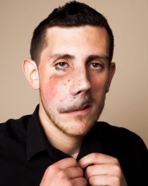 Katie Piper Instagram - Todays #MindsetMonday comes from @vmrory1993, he says “I’m Rory, I’m 30, and I was born with a birthmark called a venous malformation on my upper lip and right cheek, which I had around 20 operations on when I was younger to reduce the size of it.

Growing up I had to endure a great deal of prejudice and mental abuse which by the time I had reached my teenage years had completely shattered my confidence. I was very shy and felt like I was living a never ending nightmare.

People told me that I was ugly. People told me that they would kill themselves if they looked like me. People told me I would never achieve certain things in life, and because my confidence was so low I started to believe them.

I have now achieved everything that people told me that I wouldn’t, and more. With strength and positivity I have completely overcome the adversity I’ve faced in the past, and I want to show everyone that you can get through any low points that you might experience in your lifetime.

At one point I thought I was always going to be unhappy and shy, but here I am now happier and more confident than I ever thought I would be.I have even turned down the opportunity for further surgery to make my face ‘symmetrical’ because I am happy the way that I am.

Prejudice is a horrible thing, and nobody should ever be judged or subjected to abuse purely because of what they look like, their race, their sexuality or any other reason. There are people who have been killed due to prejudice, there are people who end their own lives due to prejudice.

There are people who aren’t comfortable in their own skin, all because of the prejudice that they have to face which is absolutely heart breaking. We live in a very multi cultural and diverse planet - and nobody should be made to feel like they don’t belong here.

Diversity is a beautiful thing, which should be celebrated and I am determined to continue do my best to help and inspire others. Never judge a book by its cover.”