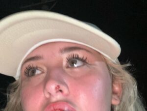 Kiera Bridget Instagram - swipe to see the before and after of me getting punched in the face by a literal man 🧍‍♂️