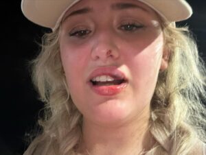 Kiera Bridget Instagram - swipe to see the before and after of me getting punched in the face by a literal man 🧍‍♂️
