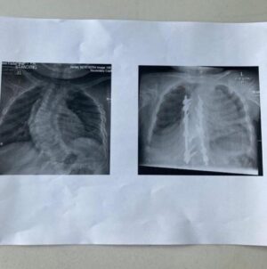 Lenny Rush Instagram - Today marks one year since my spinal fusion surgery. I cannot believe how fast time has gone, and to look at the pictures and see how I am doing now, is amazing! It was definitely a hard time, not just for me, but also my family. But seeing the X-rays and the shape of my back (and the therapy dogs that came to visit 🐶) really helped get me get through it. I am now doing better than ever! A massive thank you to @greatormondst : you’ve changed my life for the best!
(The second picture shows my X-rays. The one on the left is before the surgery, and the one on the right is after 🩻). #recovery #spinalfusionsurgery #scoliosis