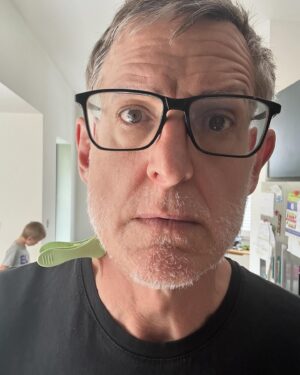 Louis Theroux Instagram - Not only is my Alopecia maybe slightly improving - I have also found a solution to the problem of neck wrinkles. See if you can guess what it is!!! In picture four I’ve shared a glimpse of one of my Alopecia patches - at the front of my scalp. The medical term is lesions. Not gonna lie - the goth in me is slightly enjoying the sudden appearance of patches and stripes of grey and white hair in my barnet. Google “Marie Antoinette Syndrome” for more on the lineage of this.