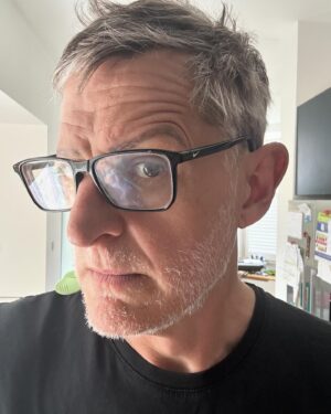 Louis Theroux Instagram - Not only is my Alopecia maybe slightly improving - I have also found a solution to the problem of neck wrinkles. See if you can guess what it is!!! In picture four I’ve shared a glimpse of one of my Alopecia patches - at the front of my scalp. The medical term is lesions. Not gonna lie - the goth in me is slightly enjoying the sudden appearance of patches and stripes of grey and white hair in my barnet. Google “Marie Antoinette Syndrome” for more on the lineage of this.