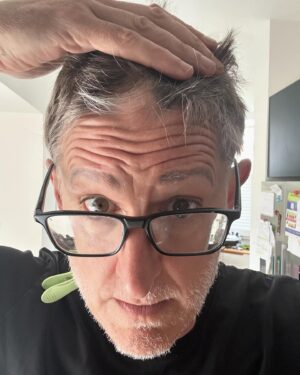 Louis Theroux Instagram - Not only is my Alopecia maybe slightly improving - I have also found a solution to the problem of neck wrinkles. See if you can guess what it is!!! In picture four I’ve shared a glimpse of one of my Alopecia patches - at the front of my scalp. The medical term is lesions. Not gonna lie - the goth in me is slightly enjoying the sudden appearance of patches and stripes of grey and white hair in my barnet. Google “Marie Antoinette Syndrome” for more on the lineage of this.