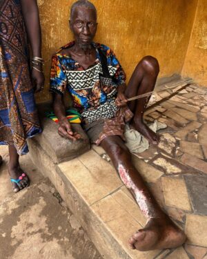 Nicholas Kristof Instagram - Any tropical disease experts out there? I met this man in northern Sierra Leone, and he told me he had had this unexplained open sore on his leg for more than six months. The doctors had no explanation (it wasn't from trauma) and offered no treatment, and it wasn't getting better. 

I think it might be Buruli Ulcer, and I wrote the words down for him and told him to show the hospital (where his wife works as an assistant nurse). But of course I have no idea, and one senior doctor in Sierra Leone I asked wasn't even sure that Buruli Ulcer existed in the country. Still, I saw dozens of similar cases of Buruli Ulcer at a hospital in the neighboring country of Liberia, where it was likewise thought that Buruli Ulcer was exceedingly rare -- and then once the hospital offered treatment, large numbers of impoverished farmers turned out to be affected. Most of the patients, like this man, were farmers who lived near swamps and were exposed to the stagnant water.

This man was very stoical, because it must be excruciatingly painful. If it is Buruli Ulcer it can be treated with a cheap antibiotic like Rifampin. I can get a message to him and his wife through someone else in the city (Makeni) who has a phone and is on Whatsapp, so is you have suggestions, let me know.