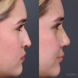 Paul Nassif Instagram - Meet my patient, Roberta! 
 
She came to me from Texas with the goals of making her nose smaller and cuter, while not having it look overdone or having the tip lifted up too much. 
 
I performed a dorsal preservation surgery where I don’t elevate the skin of the nose, but push the nose down to remove her dorsal hump. Then I performed my signature Celestial Rhinoplasty™ to elevate the tip. Finally, I did alar base reductions to the nostrils to bring them in slightly. 
 
Here are her results after only one-week, but you can already see the incredible improvement, which will continue to progress over time! Roberta and I are loving her results! 
 
🔊 Sound: On! 
 
Trusted with Noses Worldwide® 
_____________________________________________ 
 ☎️ : 1 (310) 275-2467 
 💌 : concierge@drpaulnassif.com 
 
#rhinoplasty #celestialrhinoplasty #nosejob #rinoplastia #rinoplasti #septoplasty #nosesurgery #alarbasereductions #plasticsurgeon #rhinoplastyspecialist #cosmeticsurgery #transformation #revisionhinoplasty #revisionseptoplasty #dorsalhump #dorsalpreservation #lateralcruraloverlay #rhinoplastybeforeandafter #beforeandafter #facialplasticsurgery #rhinoplastydiary #bhfyp #transformationtuesday #tt #celestialrhinoplasty #nassifmd #nassifmedical