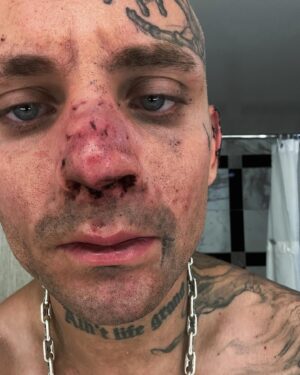Samuel Ratsch Instagram - That awkward moment when the nose doctor clears you and says be careful since the nose isn’t fully recovered …..but you get super kicked in the face with shoes that have thumbtacks glued to the bottom of them while being hung upside down. 🪦