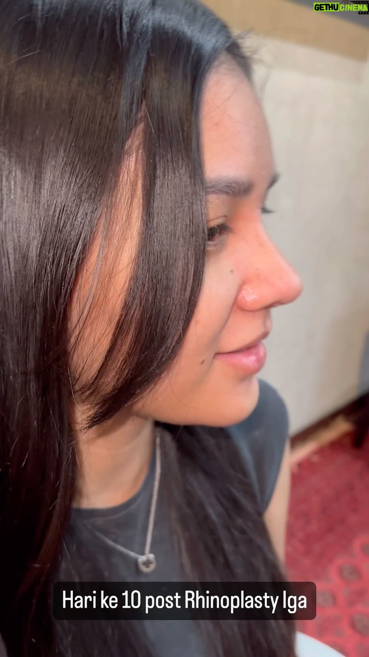 Tompi - 0.9K Likes - Nah ini update hari ke 10, rhinoplasty iga. Oh ya, mau ngabarin kl hari minggu 18 agustus sy akan visit @beyoutifulbydrtompi cab MAKASAR. Ketemu disana ya