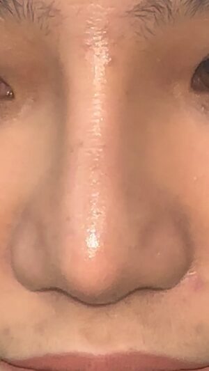 Tompi Instagram - Ini penjelasan kenapa implant hidung gak bs NATURAL HASILNYA