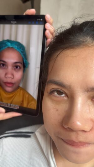 Tompi Instagram - Hari ke 3 post rhinoiga

Op inibs dikerjakan di semua cabang @beyoutifulbydrtompi 

Kl di bandung ada dr @alisundoro 
Kl di surabaya ada @alkiandana_md