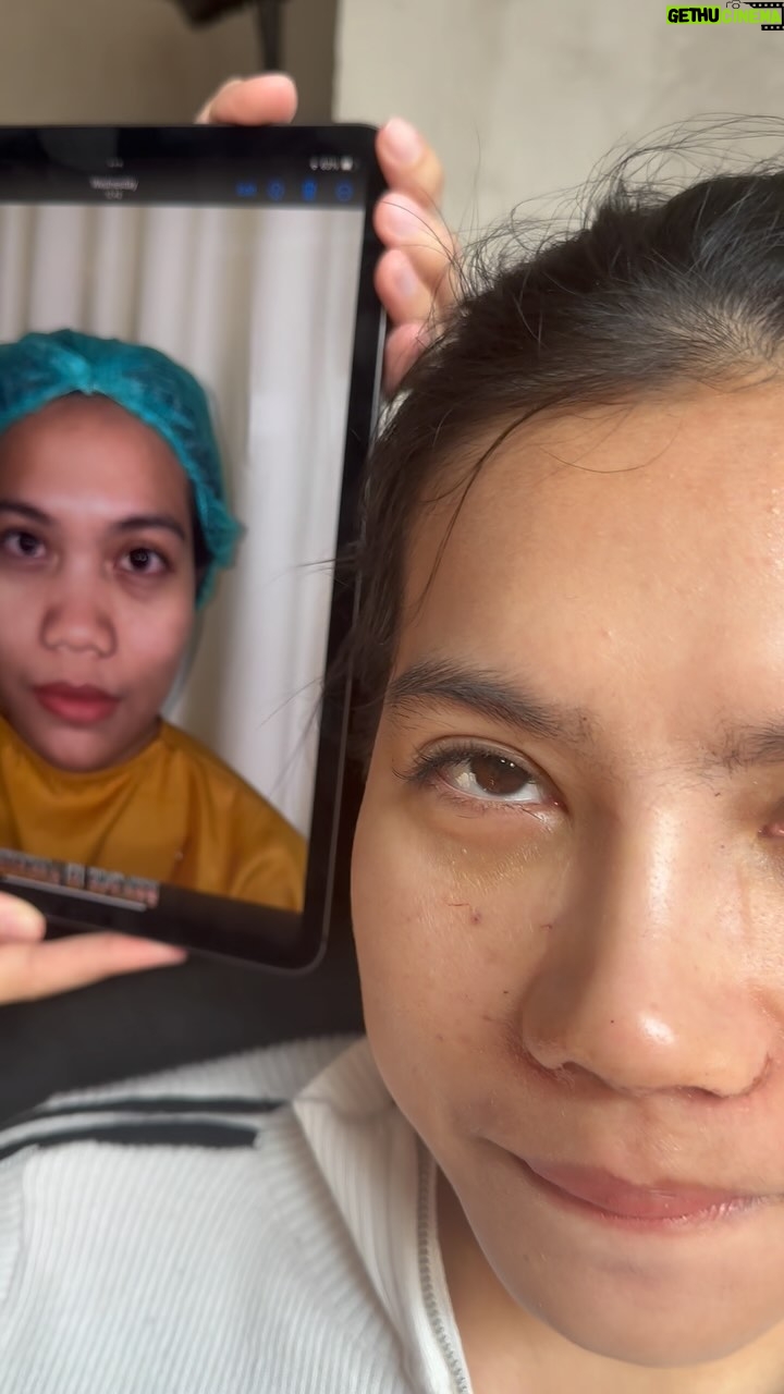 Tompi - 6K Likes - Hari ke 3 post rhinoiga
Op inibs dikerjakan di semua cabang @beyoutifulbydrtompi
Kl di bandung ada dr @alisundoro
Kl di surabaya ada @alkiandana_md