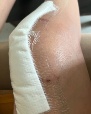 Dhivyadharshini Instagram - Long post alert 
Last 3 months have been trying times for me. 2 months ago I had a major surgery for my knee, yes I have done total knee replacement surgery, this is my 4th surgery is past 10 years on my right knee. Wishing and hoping and praying that this the final surgery for my right knee. By far it’s been a very painful recovery but with improvement. I’m working very hard on myself and my knee. After 2 months of surgery I’m putting up this post for people who loved me onscreen, and have always supported me and empathised with my pain. I’m still in wonder thinking what I’ve done to gain this unconditional love from all of you. And for the people who prayed for me all these years and who supported me at work I want to say a big THANK YOU from the bottom of my heart. It kept me going through my dark days. And I’ve always told myself not to let this pain make me a bitter person and your love aided me in doing that. Now that there is light, I promise to come back stronger (which I already am). 

Most importantly I want to thank my doctors, Dr.Suriyanarayanan sir, Dr.Clement sir, Dr.Ashok sir @sims_hospitals who performed these knee surgeries on me and who took care of me like their own. Also Dr. Suresh and Dr.Madhavan from other departments of Sims hospital. Dr. Raneesh, thank you for always helping me and many thanks to Dr. Amar Agarwal sir (eye hospital) who introduced me to Dr. Clement where it all started. I specially have to thank Dr. Karthik Anjeeneyan, who’s been my support system. Spl mention to SIMS hospital staff Prema ma’am, Dwaraka ji and many who took care of me so well (not a paid mention). 
Big thanks to my family and friends who were by my side (you know who you are)

Lastly, if you ever see me anywhere walking, and if you’re one of those who wished me well during these tough 10 years please come to me and say hi, I would like to count my blessings.

I’m getting stronger, will see you all soon 
New knee New me. 

Love 
DD Neelakandan ❤️🧿