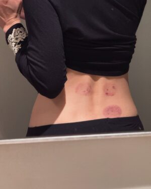 Sara Jane Ho Instagram - Cupping on the lower back and tailbone helps with cramps, irregular periods and fertility by clearing blockages in the uterus and ovaries. You can do dry cupping which doesn’t involve breaking skin or wet cupping where your practitioner makes small incisions on your skin followed by suction cups that allow blood to flow into the cup. Wet cupping is more effective - if I’m late, I go for wet cupping and my period comes ON THE DAY.

Pic 1 and 3 are dry cupping - every trip to China I swing by Hangzhou just to double up on my TCM needs - tuina medical massage, acupuncture, cupping and herbs. Hangzhou has been the centre of Chinese medicine for thousands of years so they have the best doctors.

I recently came back to LA and pic 4 shows incision marks from wet cupping. They go away after a week. I see Dr Jae Kim at Acumedi Health in Koreatown, he is excellent.