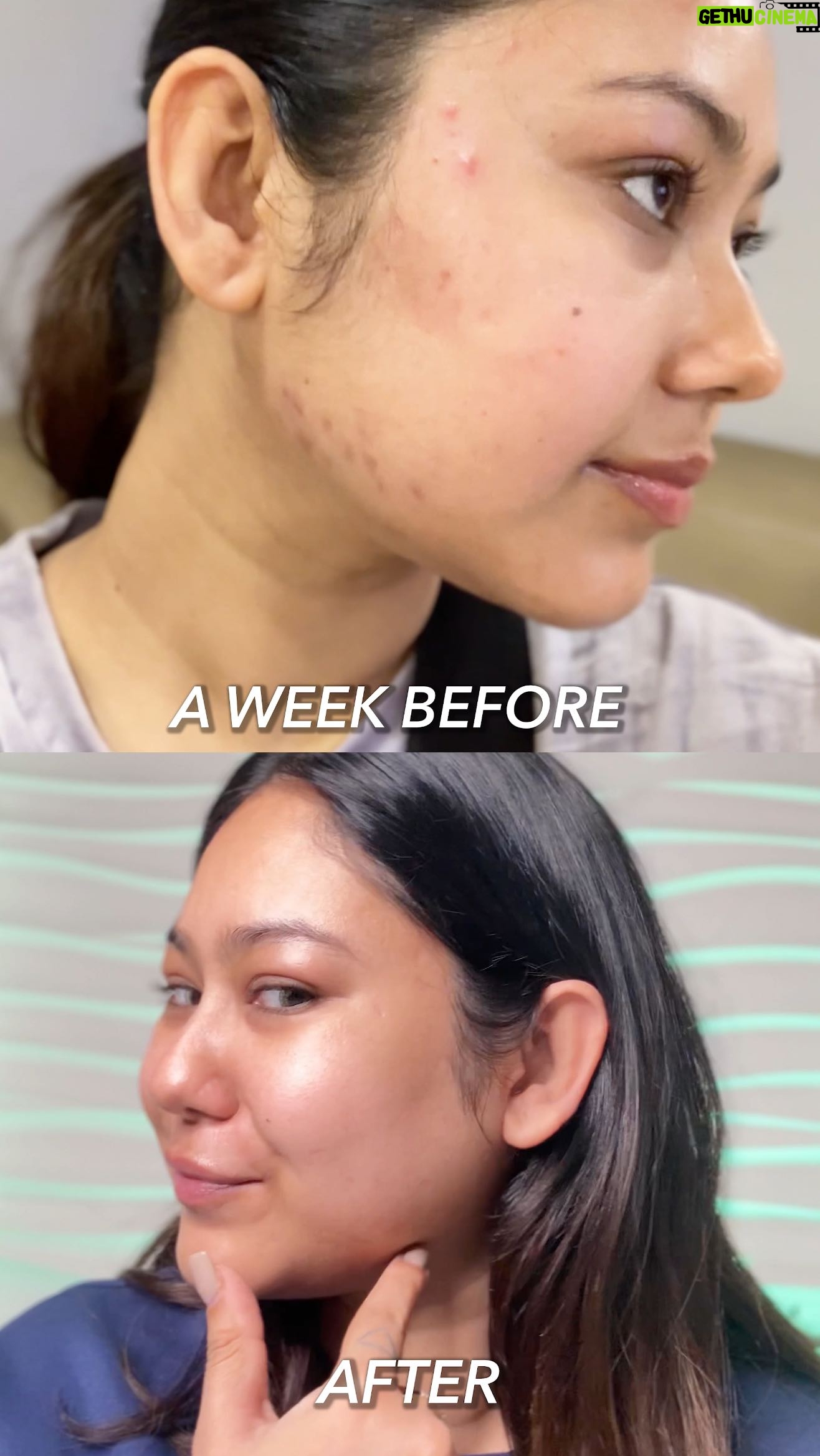 Aditi Shrestha - 5.4K Likes - PCOS girlie on a mission today:
💪 Protein-packed breakfast
📸 Content shoot
🫶🏼Self-care therapy!
Aaaaand my favourite @novologyofficial Acne Reduction Serum to the rescue for hormonal acne.
Lightweight, dermatologist-approved, and perfect under makeup. Skin feels fresh & clear in a week! 🌿
#Ad #MiniVlog #PCOSJourney #Acne #Skincare