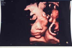 Son Dam-bi Instagram - 3D 입체 초음파
누구 닮은 것 같아?😊
난 남편인 것 같기도 하고🤣🤣👶🏻