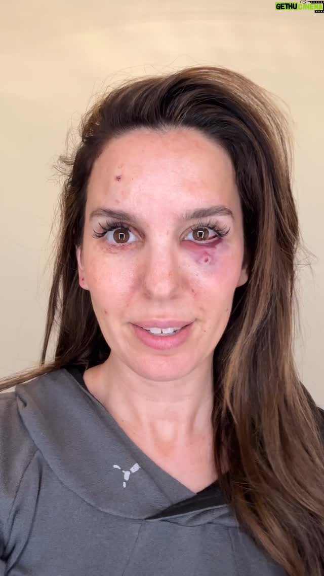 Christy Carlson Romano - 131K Likes - Yesterday was my husband’s birthday and I took him to shoot clay pigeons as a present. There was another party with us and they unsafely fired in the wrong direction and shot me in the face. @thebrendanrooney immediately sprung into action, assessed me, and rushed me to the hospital. I was hit in 5 places, one was less than an inch from hitting me directly in my right eye.
Unfortunately a fragment got lodged behind my eye and it is too risky to remove surgically at this time. Doctors will continue to monitor me (I can see normally at the moment).
With everything that happened, all I can think about is how grateful I am to be alive. I love my daughters, husband, family, and friends so much. I saw my life flash before my eyes and I’m telling you, hug the people around you every chance you can. Life can change in an instant. 🙏