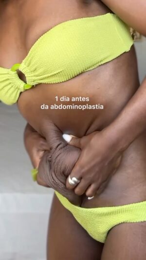 Yolanda Tati Instagram - Antes e Depois: 7 dias pós-cirurgia ❤️‍🩹

1 semana depois da minha abdominoplastia: remoção de excesso de pele   correção de diástase   cirurgia de remoção de hérnia umbilical com reconstrução… E eu nem acredito que esta é a minha barriguinha nova: Eu estou muito feliz! 🤩🥹 inexplicável… agora percebo ainda mais o peso que isto sempre teve para mim.

⏱️ Considerem que eu ainda estou MUITO inchada. As marcas laterais são apenas da cinta, que temos de usar  devidamente apertada, 24H (retirei apenas 5min para gravar isto).

🩹 Umbigo novinho, em processo de cicatrização com pontos, levou um implante de rede, porque a hérnia era grande, para evitar que volte.

⏳ Esta barriga ainda vai mudar MUITO nos próximos meses. Quero muito chegar ao resultado final, mas também acho importante mostrar esta parte e abraçar a Recuperação, Processo e a Evolução. 

(Recuar 2 e 3 vídeos para entender o meu diagnóstico, condição e motivações para estas cirurgias 🫶🏾)
👩‍⚕️ A minha Super Médica: @drasaracunha.pt
💎 A super Equipa e Clínica @clinicaonyx 

#abdominoplastia #antesedepois #cirurgiaplástica