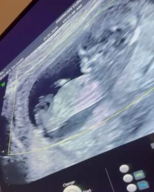 Dafina Zeqiri Instagram - Baby on board 💙

Dua te shpreh nje falenderim te posaqem per gjithe stafin e Klinikes Amerikane Dr Behar Kusari per perkushtimin e tyre dhe mbi te gjitha perkrahjen emocionale dhe mbeshtetjen ne cdo moment. Qasja e tyre profesionale ne rrugetimin me te rendesishem jetesor, eshte nje motiv per secilen femer qe te perjetoj momentet me te lumtura jetesore dhe te ndjehesh e lire te bisedosh per cfaredo shqetesimi dhe te pranosh mbeshtetje 24h nga ekipa.

Une kam vendos qe shtatzenine ta percjell ne American Clinic dr Behar Kusari sepse gjithmone kam besuar dhe e kam vertetuar se ne Kosove mund te ndjehesh e sigurte te marresh trajtimet shendetesore prandaj dhe kam vendosur qe te lind dhe djali im te kete vendlindjen ne Kosove, edhe pse kam pasur mundesi te kthehem ne Suedi dhe ta kryej.