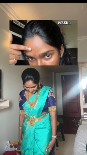Dharshini Sambathkumar Instagram - You will be shocked to see the final results 😩 A month before my cousin sister’s wedding, I started my skin transformation journey. Battling uneven skin tone and dullness, I turned to @mywishcare Wishcare Brightening C16 Serum, with Kojic Acid and Niacinamide, and it made a huge difference in my skin. Here’s how my skin improved over four weeks, with visible results week by week 😭❤️ 
Comment link 🔗 
. 
#skin #collab #brightening#skinjourney #transformation