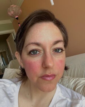 Dianna Cowern Instagram - One of my diseases is MCAS (Mast Cell Activation Syndrome) where mast cells, that are supposed to alert your immune system there’s something harmful in your body, react to something benign. It makes my cheeks (mostly the right one) flush red. Plus makes me dizzy, nauseous, and exhausted. In this case it was probably the hypoallergenic unscented soap I used on my face. 🫠 #longcovid #mcas #mecfs