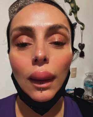 Ivonne Montero Instagram - Pueden creerlo? 😳 Así terminó mi día anoche.. el doctor me comentó que eso no fue un piquete de ningún insecto que fue reacción alérgica algún alimento que ingerir. La verdad no soy alérgica a nada me extrañó muchísimo, además de pensar lo peligroso que puede ser.. pero ya con el medicamento que me mandó todo volvió prácticamente a la normalidad..! QUE SUSTO JAJAJA ! 😅🤪 gracias por todos sus mensajes que me enviaron.. LOS AMO TANTO!
✨🦋💞🦋✨