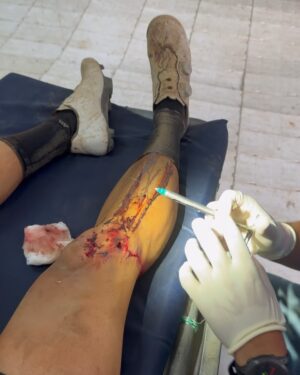 Johanna Solano Instagram - Ya cansada de llorar hoy decido transformar mi dolor en palabras con el corazón roto desde mi cama de hospital, en lo que se supone que sería mi 5to día de carrera en @capeepic. 💔

El dolor físico va más allá de cualquier cosa que haya sentido, pero no se compara con el dolor que siento en el corazón por ver un sueño terminado de una forma tan abrupta. Trabajé y trabajé incansablemente por meses con un único objetivo, tuve días buenos, otros no tan buenos, me he caído y me he levantado. Jamás imaginé que la primer caída de la que no podría levantarme sería justamente mientras cumplía uno de mis sueños deportivos más grandes.

No estoy acostumbrada a que algo me detenga. No está en mi “chip” retirarme de nada. Toda mi cabeza, mi alma, mi espíritu quieren continuar con todas sus fuerzas, pero mi cuerpo no lo permite. Sé que los planes de Dios son perfectos y hoy intento con humildad aceptar que así tenía que ser, aunque me cueste todas mis lágrimas.

Ahora sólo en espera de una pequeña cirugía en mi rodilla y algunos días hospitalizada, pero llena de buena compañía y mucho amor. ❤️ ¡Gracias por todos sus buenos deseos y palabras de aliento!

P.D.: ¡Glori sigue en competencia! Mandémosle todas las buenas vibras porque afrontar las etapas que quedan, ahora solita, va a requerir de mucha cabeza. 🙏🏽 Gracias partner por todo tu apoyo, te quiero!