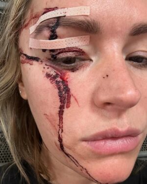 Laura Woods Instagram - Just wanted to explain my absence from the telly for a little while, to be totally transparent and avoid any speculation. I had an accident last weekend at a holiday cottage. I swung a pillow and hit a large, glass lampshade hanging from the ceiling above me, which shattered and cut my face and arms, but luckily missed my eye. 

I wanted to say a couple of thank yous, firstly to Adam, for being my hero that day, acting so quickly and not leaving my side since and to his family for taking care of me in a time when I was petrified. To my agents Alex Maguire and Matthew Odonohue at CAA who searched for the best help immediately. To Dr Yannis Alexandrides and his wonderful medical assistant Zuzanna at 111 who opened their emergency surgery and came in on their days off, they were so gentle and have already worked magic that I didn’t think was possible to reduce the damage. 

I’ve added in the photos from then to now to show that even though it may look rough, it’s such a wonderful improvement already and I’m so grateful 🤍

It was a hell of a shock and I’ve been a bit sad, but I’m feeling very lucky it wasn’t worse. So a big thanks to my eyebrow too, for taking the brunt of it 😂 

I’m gutted I can’t cover the fight in Riyadh tomorrow anymore, but wishing the brilliant TNT boxing team all the best 🤍 

Be back soon xx