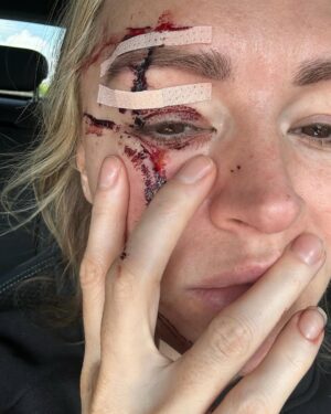 Laura Woods Instagram - Just wanted to explain my absence from the telly for a little while, to be totally transparent and avoid any speculation. I had an accident last weekend at a holiday cottage. I swung a pillow and hit a large, glass lampshade hanging from the ceiling above me, which shattered and cut my face and arms, but luckily missed my eye. 

I wanted to say a couple of thank yous, firstly to Adam, for being my hero that day, acting so quickly and not leaving my side since and to his family for taking care of me in a time when I was petrified. To my agents Alex Maguire and Matthew Odonohue at CAA who searched for the best help immediately. To Dr Yannis Alexandrides and his wonderful medical assistant Zuzanna at 111 who opened their emergency surgery and came in on their days off, they were so gentle and have already worked magic that I didn’t think was possible to reduce the damage. 

I’ve added in the photos from then to now to show that even though it may look rough, it’s such a wonderful improvement already and I’m so grateful 🤍

It was a hell of a shock and I’ve been a bit sad, but I’m feeling very lucky it wasn’t worse. So a big thanks to my eyebrow too, for taking the brunt of it 😂 

I’m gutted I can’t cover the fight in Riyadh tomorrow anymore, but wishing the brilliant TNT boxing team all the best 🤍 

Be back soon xx
