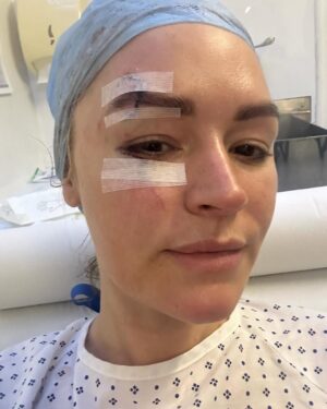Laura Woods Instagram - Just wanted to explain my absence from the telly for a little while, to be totally transparent and avoid any speculation. I had an accident last weekend at a holiday cottage. I swung a pillow and hit a large, glass lampshade hanging from the ceiling above me, which shattered and cut my face and arms, but luckily missed my eye. 

I wanted to say a couple of thank yous, firstly to Adam, for being my hero that day, acting so quickly and not leaving my side since and to his family for taking care of me in a time when I was petrified. To my agents Alex Maguire and Matthew Odonohue at CAA who searched for the best help immediately. To Dr Yannis Alexandrides and his wonderful medical assistant Zuzanna at 111 who opened their emergency surgery and came in on their days off, they were so gentle and have already worked magic that I didn’t think was possible to reduce the damage. 

I’ve added in the photos from then to now to show that even though it may look rough, it’s such a wonderful improvement already and I’m so grateful 🤍

It was a hell of a shock and I’ve been a bit sad, but I’m feeling very lucky it wasn’t worse. So a big thanks to my eyebrow too, for taking the brunt of it 😂 

I’m gutted I can’t cover the fight in Riyadh tomorrow anymore, but wishing the brilliant TNT boxing team all the best 🤍 

Be back soon xx